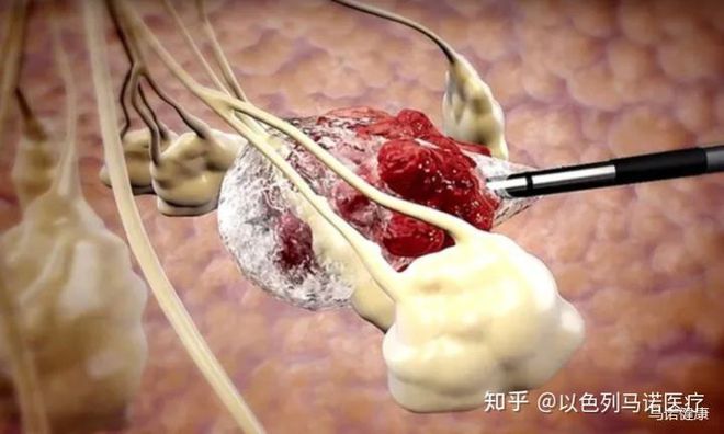 以色列IceCure公司下一代冷冻消融技术成功治kaiyun中国平台疗复发性肾肿瘤(图1)