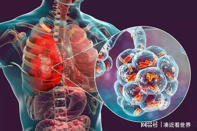 6死111感染!美国纽约军团病再暴发冷却塔成“隐形杀手”……(图4) 6死111感染!美国纽约军团病再暴发冷却塔成“隐形杀手”……(图4)